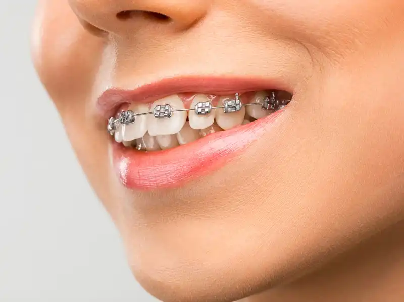 Orthodontic Treatment